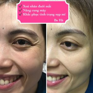 Trẻ hoá da là gì?