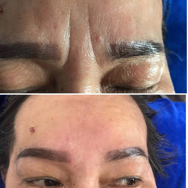 Trước và sau liệu trình