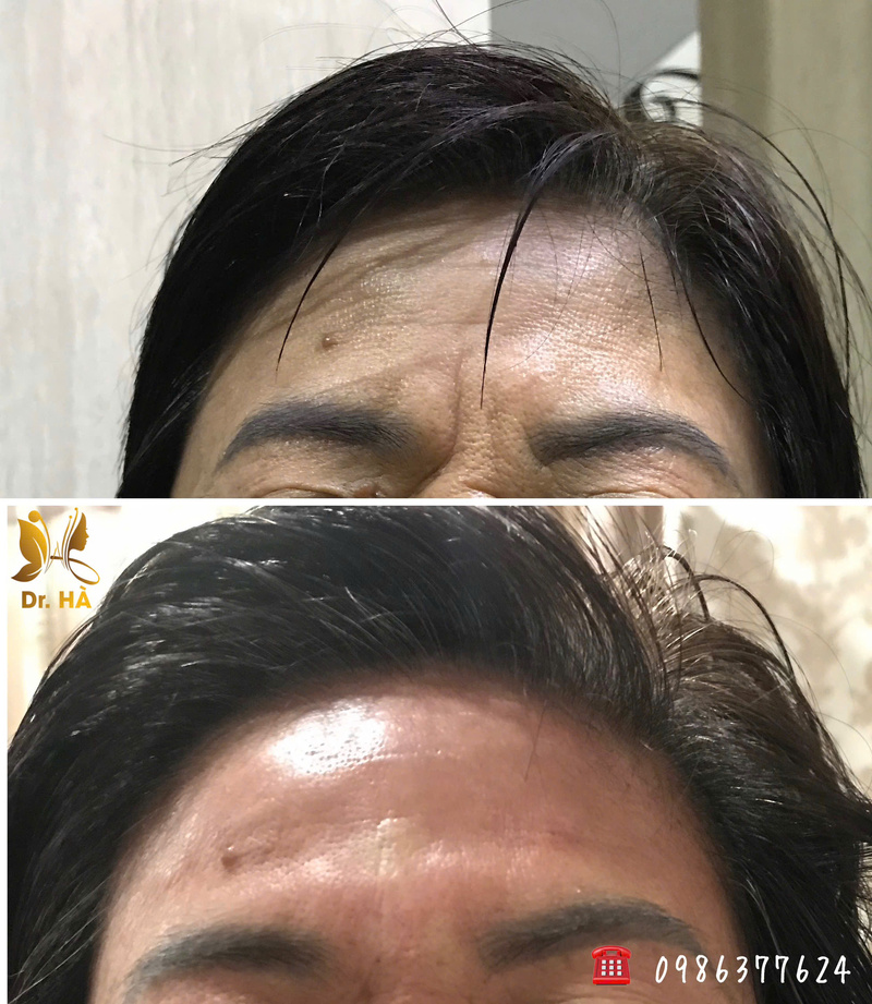 Điểm khác biết của trẻ hoá da